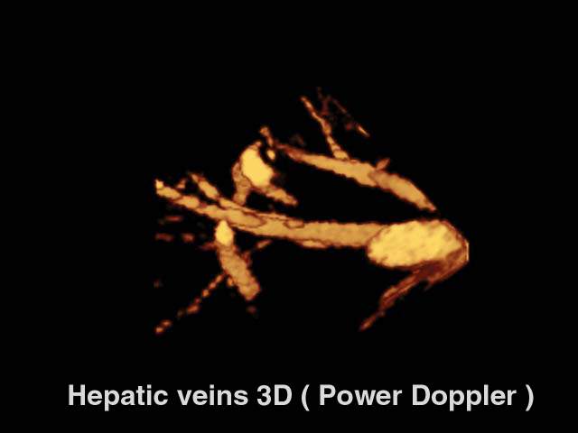 Hepatic veins, power doppler, 3D (echogramm №169)