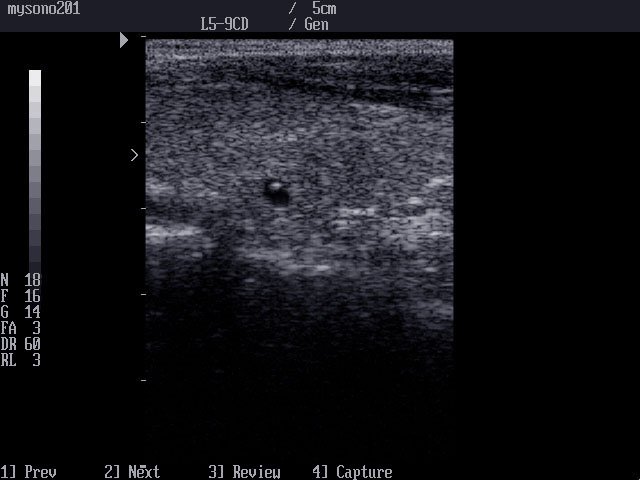 Thyroid cyst, B-mode (echogramm №17)