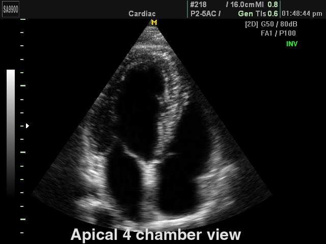 Heart (4 chamber view), B-mode (echogramm №173)