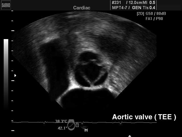 Aortic valve (transesophageal echocardiography), B-mode (echogramm №175)