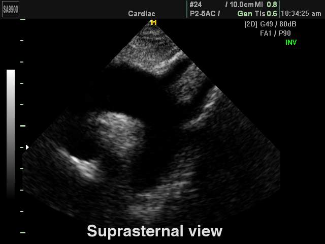 Heart (suprasternal view), B-mode (echogramm №176)