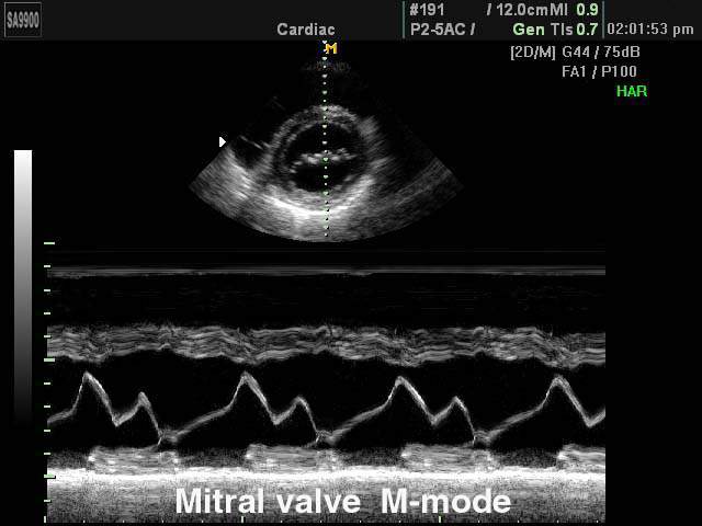 Mitral valve, M-mode (echogramm №177)