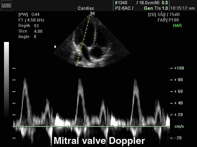 Mitral valve, PW (echogramm №179)