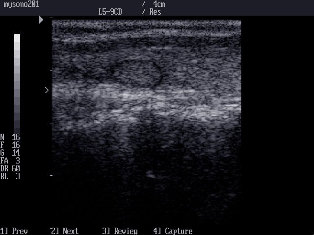 Thyroid nodule, B-mode (echogramm №18)