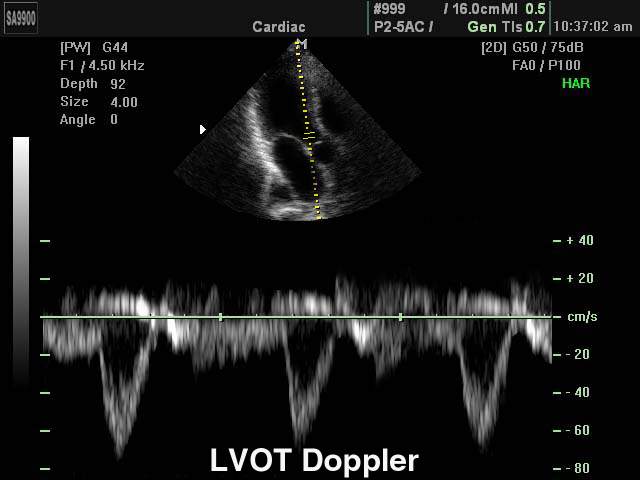 Left ventricular - outflow tract, PW (echogramm №180)