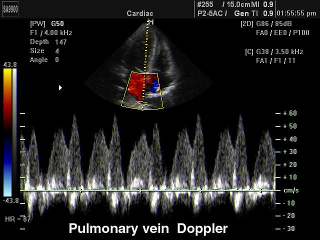 Pulmonary vein, CFM & PW (echogramm №181)