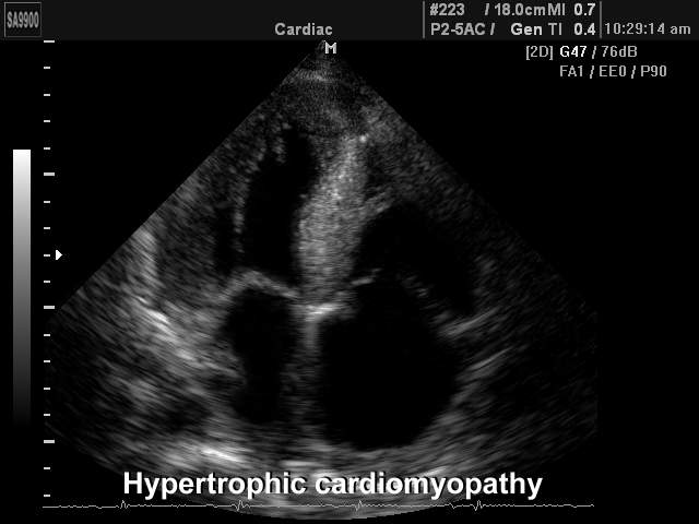 Hypertrophic cardiomyopathy, B-mode (echogramm №185)