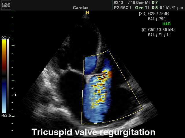 Tricuspid valve regurgitation, color doppler (echogramm №188)