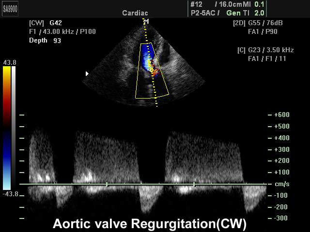 Aortic valve regurgitation, CFM & CW (echogramm №189)