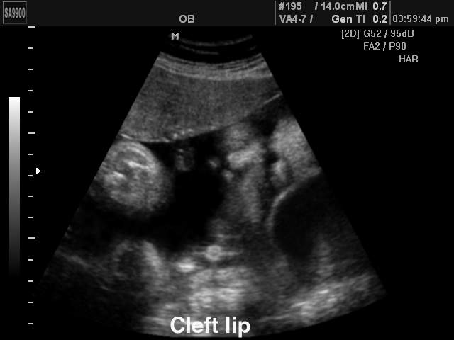 Fetal сleft lip, B-mode (echogramm №193)
