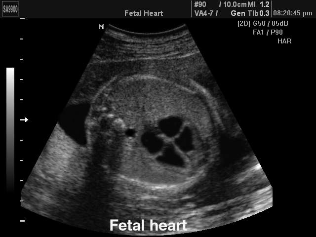 Fetal heart, B-mode (echogramm №194)