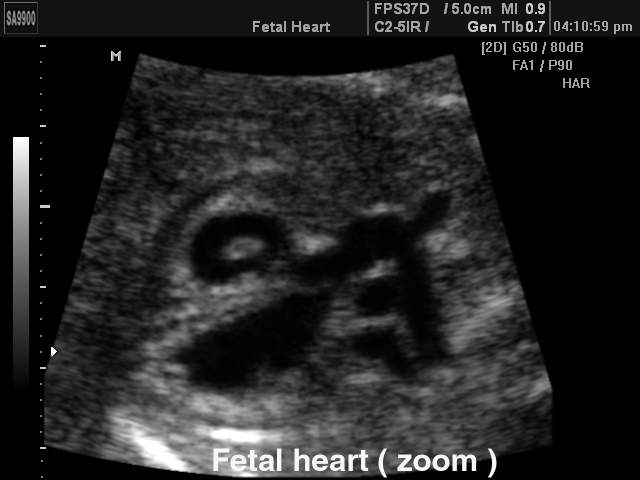 Fetal heart, B-mode (echogramm №195)