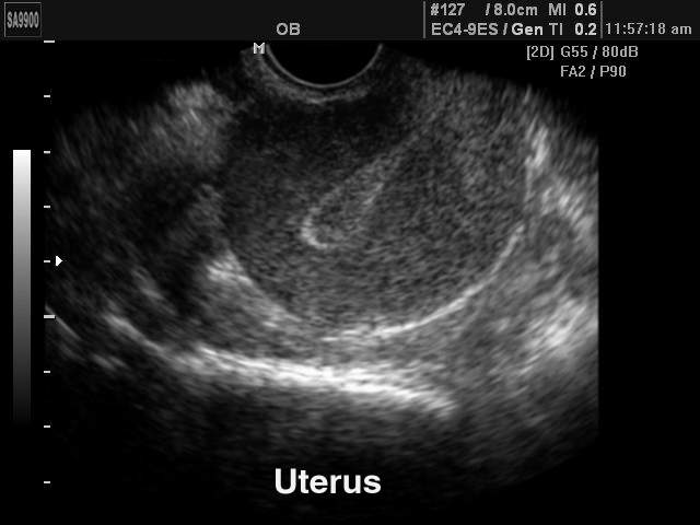 Uterus, B-mode (echogramm №197)