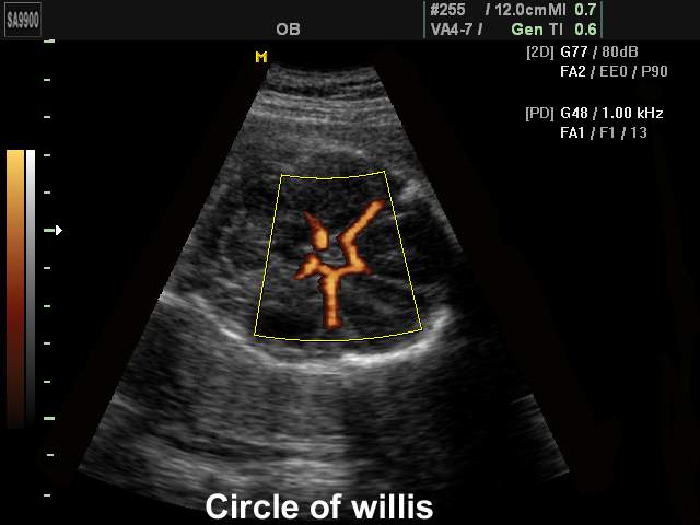 Circle of Willis, power doppler (echogramm №199)