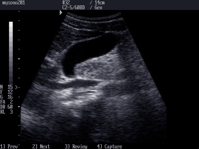 Gall bladder, B-mode (echogramm №2)