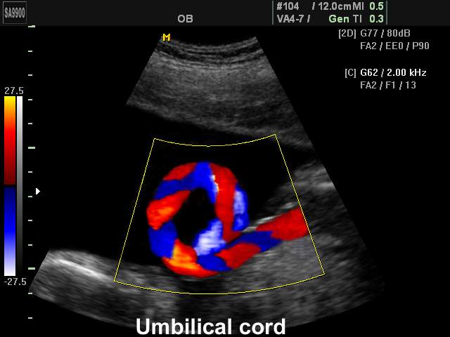 Umbilical cord, color doppler (echogramm №200)