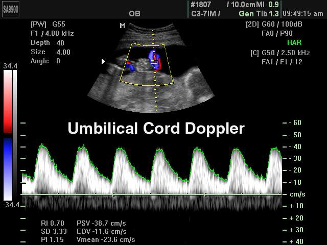 Umbilical cord, CFM & PW (echogramm №201)