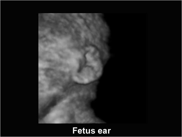 Fetal ear, B-mode (echogramm №202)