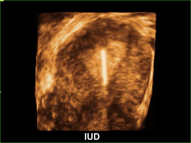 Uterus and lippes loop, 3D (echogramm №204)