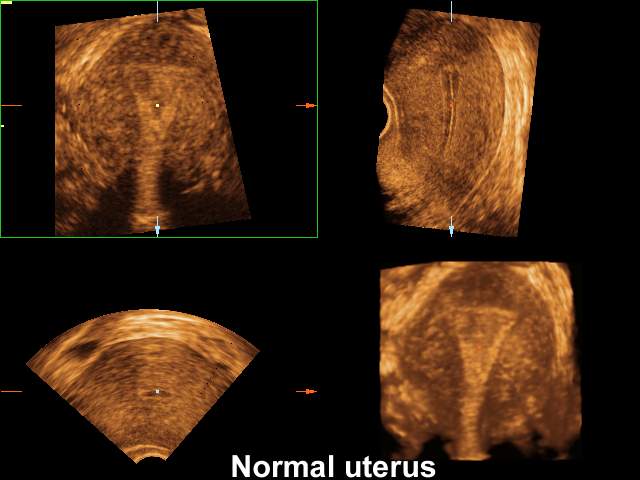 Uterus - norm, 3D (echogramm №205)