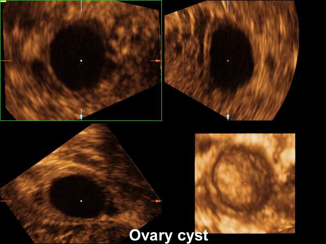Ovarian cyst, 3D (echogramm №206)