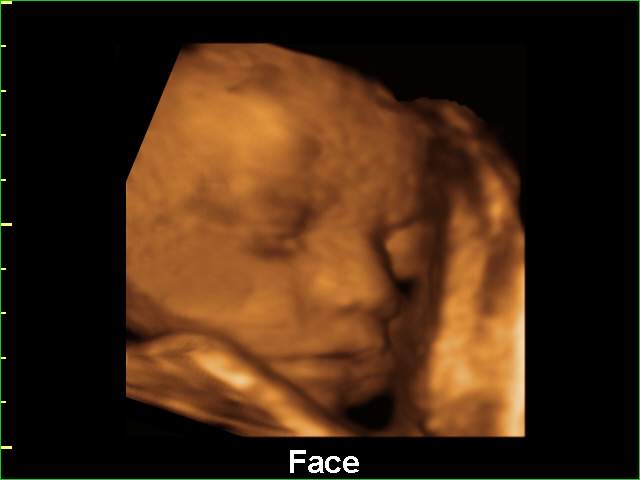 Fetal face, 3D (echogramm №209)