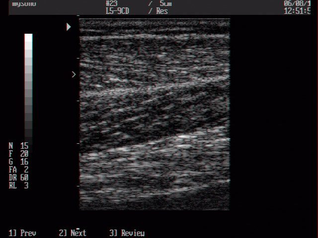 Gastrocnemius muscle, B-mode (echogramm №21)