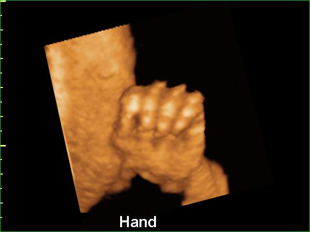 Fetal hand, 3D (echogramm №210)