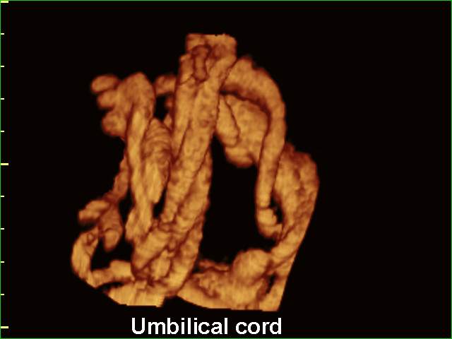 Umbilical cord, 3D (echogramm №211)