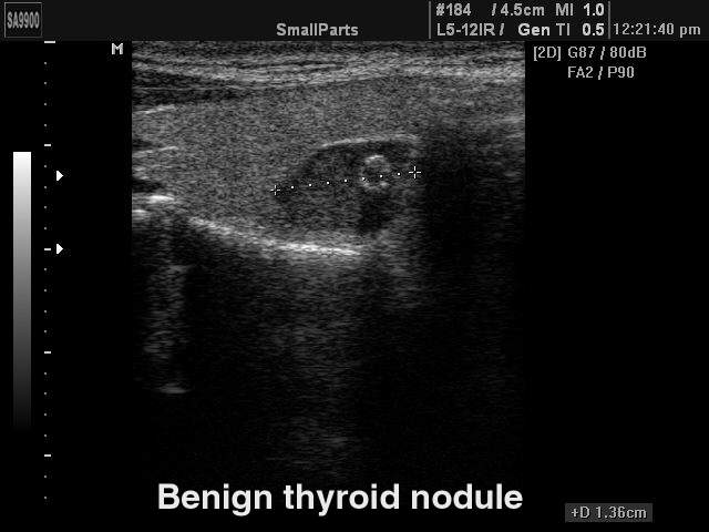 Thyroid benign nodule, B-mode (echogramm №215)