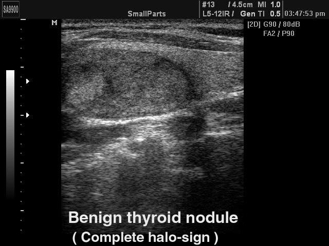 Thyroid benign nodule, B-mode (echogramm №216)