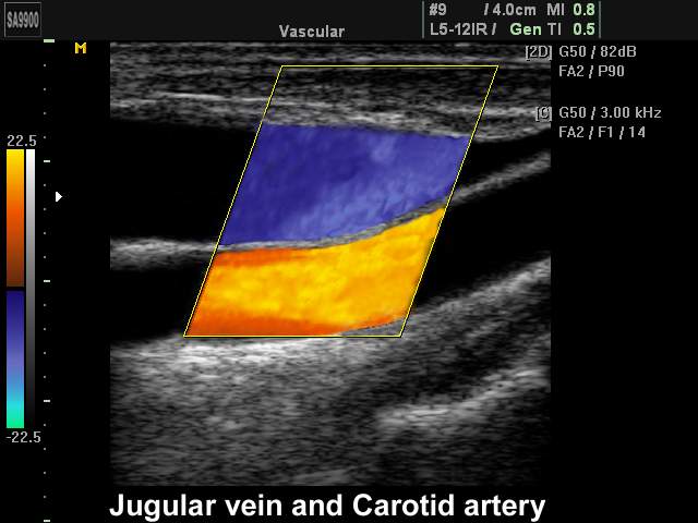 Jugular vein and сarotid artery, color doppler (echogramm №218)