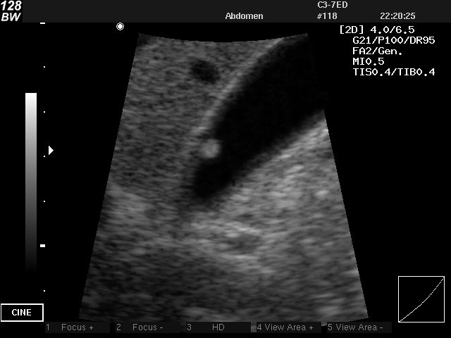 Gall bladder polyp, B-mode (echogramm №22)