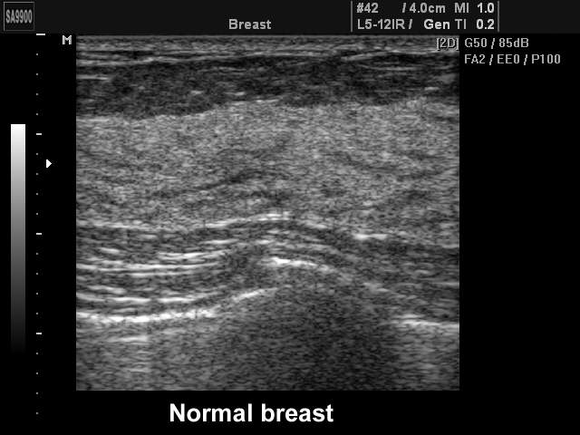 Breast - norm, B-mode (echogramm №220)