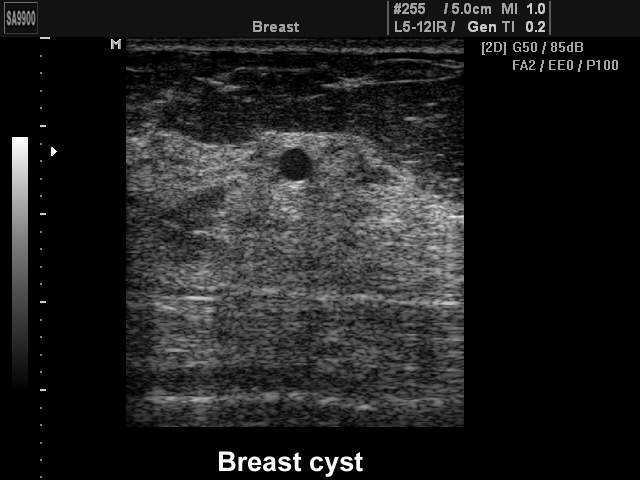 Breast cyst, B-mode (echogramm №221)