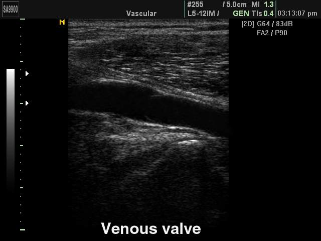 Venous valve, B-mode (echogramm №223)