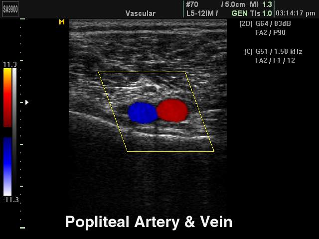 Popliteal аrtery and vein, color doppler (echogramm №224)