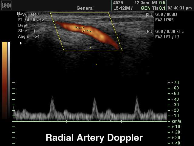Radial artery, PD & PW (echogramm №226)