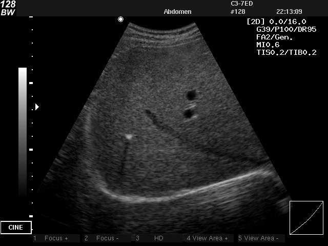 Intrahepatic calcification, B-mode (echogramm №23)