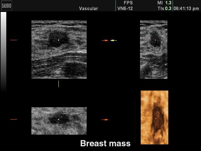 Induration of the breast, 3D reconstruction (echogramm №231)