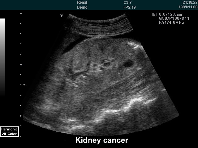 Kidney cancer, B-mode (echogramm №232)