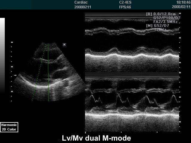 Left ventricle and mitral valve, M-mode (echogramm №233)