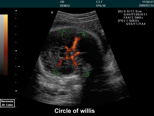 Circle of Willis, power doppler (echogramm №234)