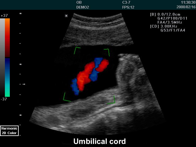 Umbilical cord, color doppler (echogramm №235)