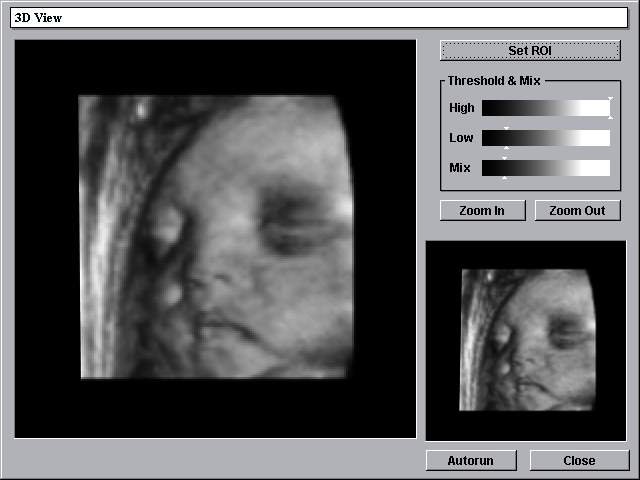 Fetal face, 3D View (echogramm №236)