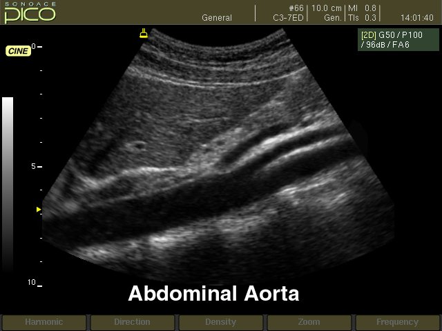 Abdominal aorta, B-mode (echogramm №239)