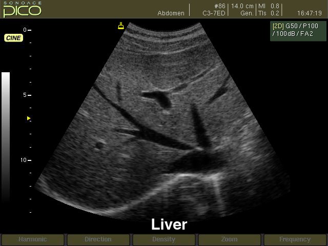 Liver, B-mode (echogramm №240)