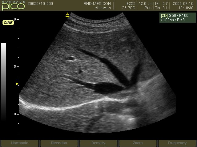 Hepatic vein, B-mode (echogramm №242)