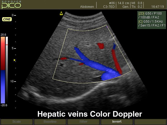 Hepatic vein, color doppler (echogramm №243)