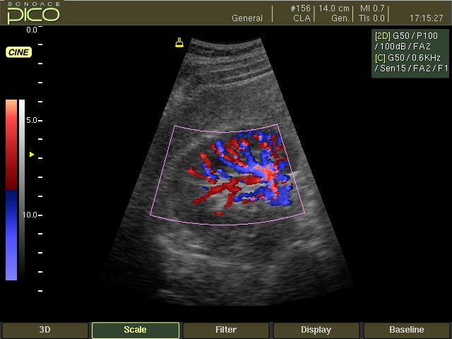 Kidney, color doppler (echogramm №244)